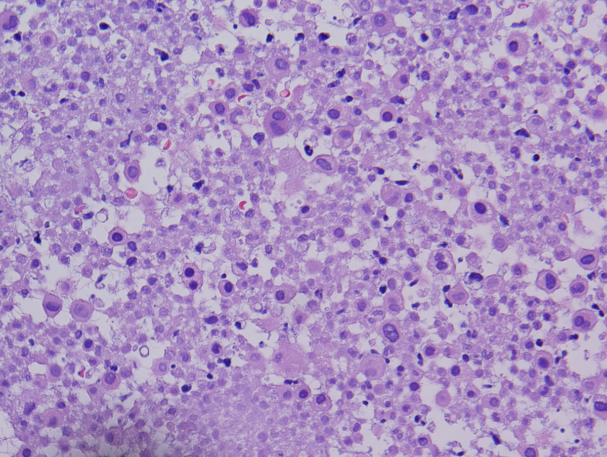 H&E of the pleural biopsy showing EMH